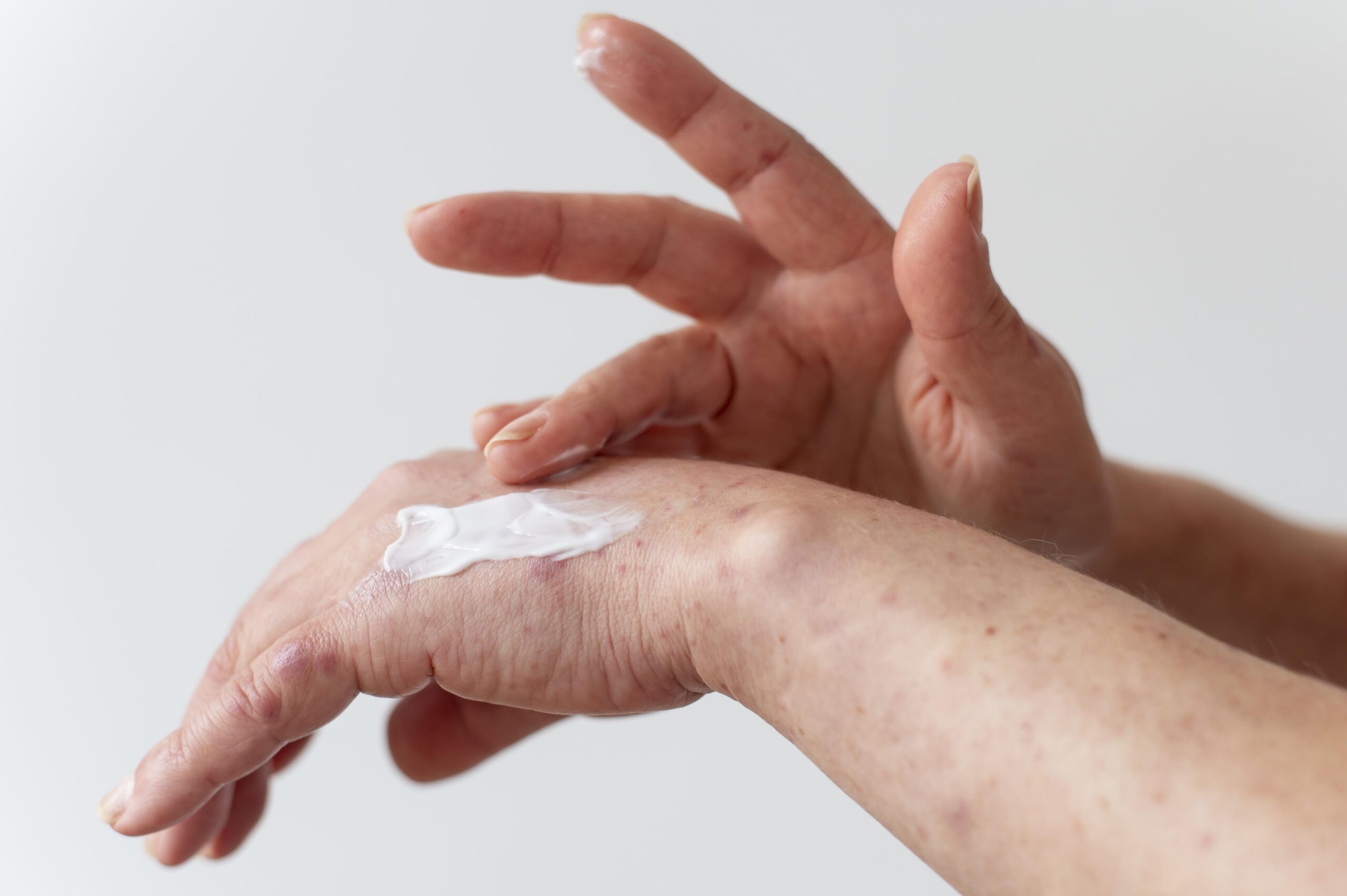 Dermocosmética y piel atópica: cómo cuidarla y prevenir los brotes